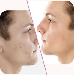 Merkloos Pimple Patch - Acne Patch - Puisten Patch - Acne Sticker - Puisten Pleister - Pimple Patches - Acne Pleister - Puisten Verwijderaar - Puisten Creme - Acne Verwijderen Set - Acneverzorging | 36 Stuks & Directe Levering -Verzorgingsproducten 1176x1200 4