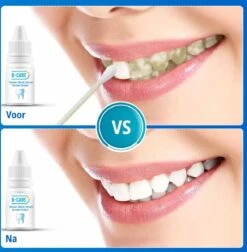 B-care Tanden Bleker – Wittere Tanden – Teeth Whitening Strips – Professioneel Resultaat - Tandsteen Verwijderaar - Zonder Peroxide - Tandenbleekset - Tanden Bleken -Verzorgingsproducten 1177x1200 13