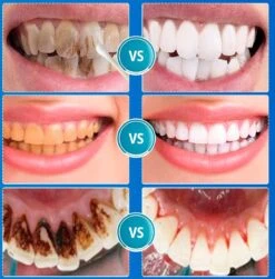 B-care Tanden Bleker – Wittere Tanden – Teeth Whitening Strips – Professioneel Resultaat - Tandsteen Verwijderaar - Zonder Peroxide - Tandenbleekset - Tanden Bleken -Verzorgingsproducten 1181x1200 9