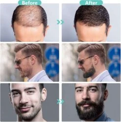 Dermaroller 0.5 Mm & Desinfectie Alcohol Spray - 540 Naalden - Steriel Verpakt -Verzorgingsproducten 1190x1200 9