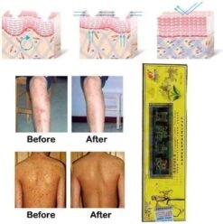 Psoriasis/exzeem Chineese Creme 13 Psoriasis/exzeem Chineese Creme -Verzorgingsproducten 1195x1200