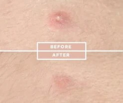 COSRX Acne Pimple Master -Verzorgingsproducten 1200x1008 2