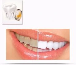 Merkloos Tanden Whitener Pen - Professionele Tandenbleek Gel - Tandenbleker -Verzorgingsproducten 1200x1026 5