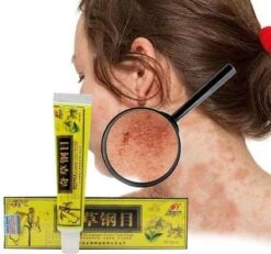 Psoriasis/exzeem Chineese Creme