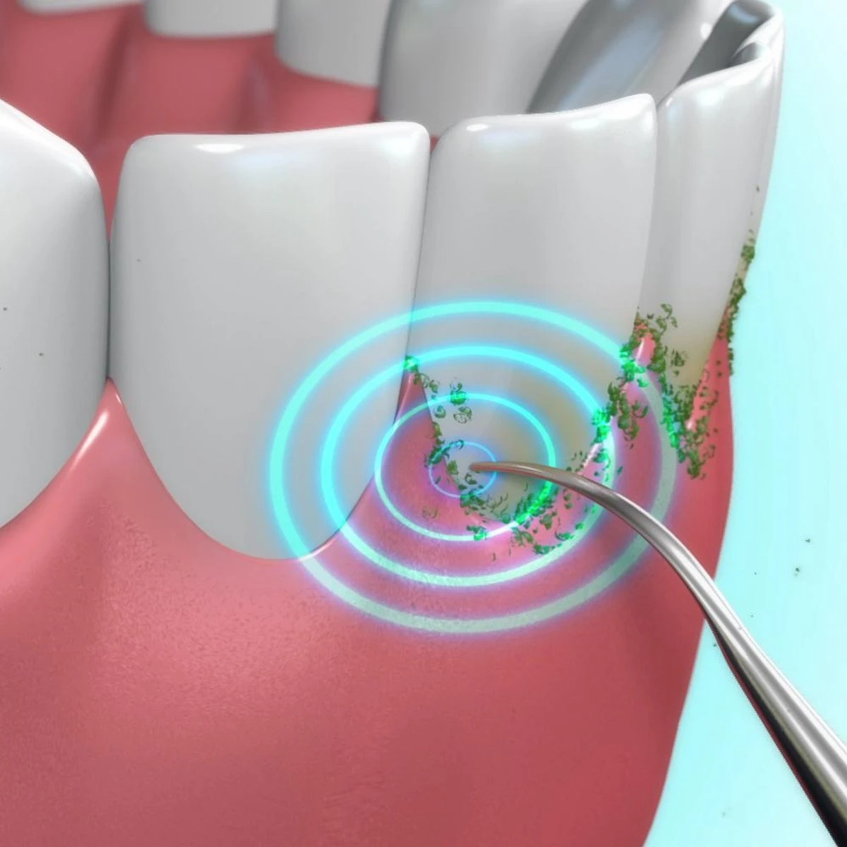 Toppers Van TV - Sonic Tandsteenverwijderaar - Tandplakverwijderaar 6 Toppers Van TV - Sonic Tandsteenverwijderaar - Tandplakverwijderaar - Afbeelding 6