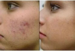 Merkloos Dermaroller 0.3mm Needle - Micro Needling Roller - Anti Acne/Cellulitis/Rimpels/Littekens/Striae Lichaams & Gezichts Roller -Verzorgingsproducten 1200x809 3