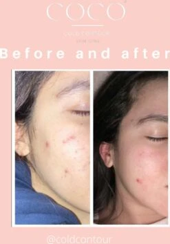 COLDCONTOUR - Skin Ice Roller Gezicht- Facial Icing- Roze - Aftersun- Cadeautip - Anti Rimpel- Ice Globes - Ijs Gezicht - Gezichtsmassage Roller - Huidverjongingsapparaat - Anti Aging- Cadeau 35 COLDCONTOUR - Skin Ice Roller Gezicht- Facial Icing- Roze - Aftersun- Cadeautip - Anti Rimpel- Ice Globes - Ijs Gezicht - Gezichtsmassage Roller - Huidverjongingsapparaat - Anti Aging- Cadeau -Verzorgingsproducten 839x1200 1