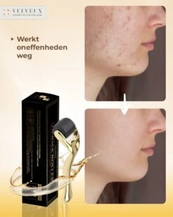 Dermaroller – 540 Micro Naalden – 0.5 MM Needle – Huidverjonging – Huidverzorging – Littekens – Striea – Steriel Verpakt -Verzorgingsproducten 960x1200 51